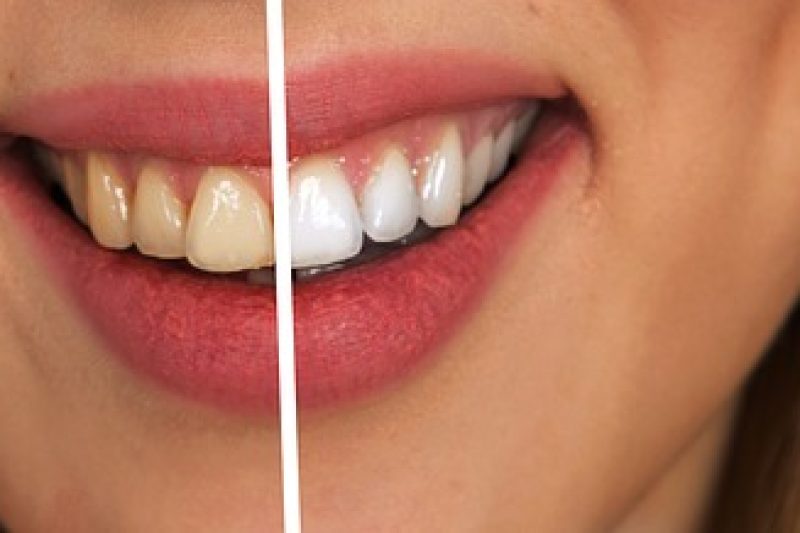 Dangers of “Do-It-Yourself” Teeth Whitening