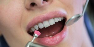 Dentist polishing a patient's teeth with a dental tool, showcasing restorative care following a root canal and crown procedure.