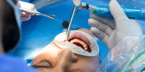 Dentist performing a precise surgical procedure on a patient's mouth, illustrating key steps before recovering after dental implant surgery.